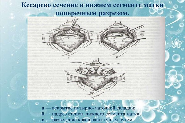 Принцип кесарева сечения в нижнем сегменте матки