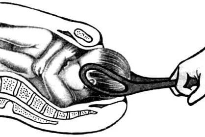 Выходные акушерские щипцы при переднем виде затылочного предлежания