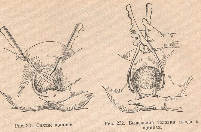 Снятие щипцов и выведение головки плода в щипцах