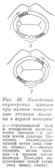 Наложение щипцов при низком поперечном стоянии головки