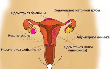 Виды эндометриоза