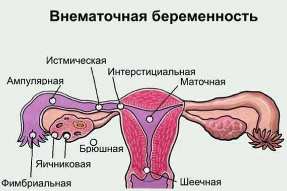 Сущность внематочной беременности