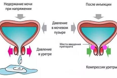 Лечение недержания мочи при напряжении с помощью инъекции