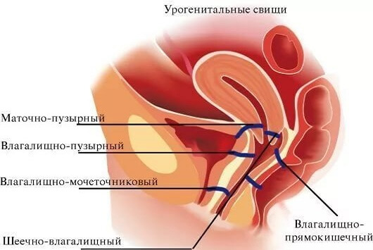 Виды свищей