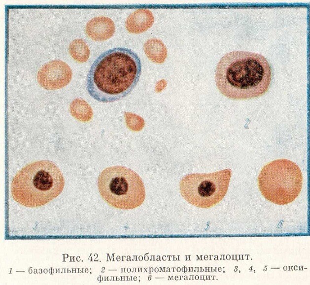 Мегалобласты и мегалоцит