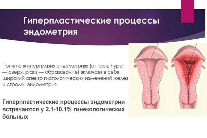 Что такое гиперпластические процессы эндометрия