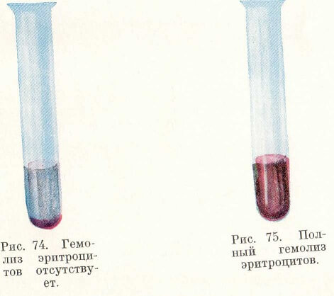 Гемолиз эритроцитов