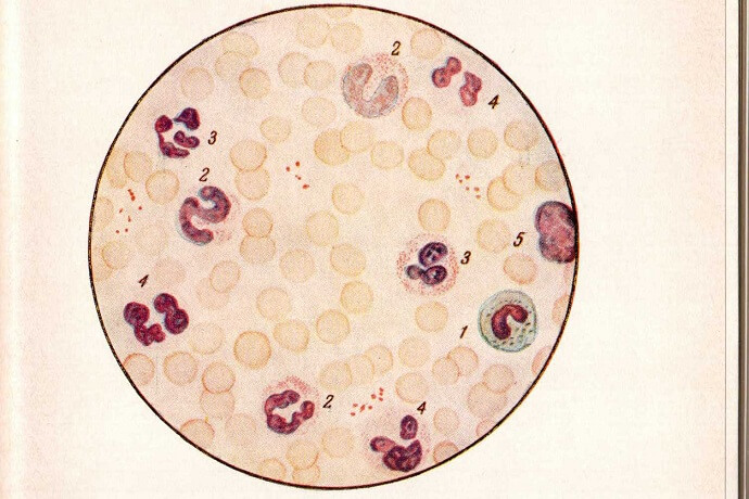 Микрофотография. Мазок крови при нейтрофильном лейкоцитозе