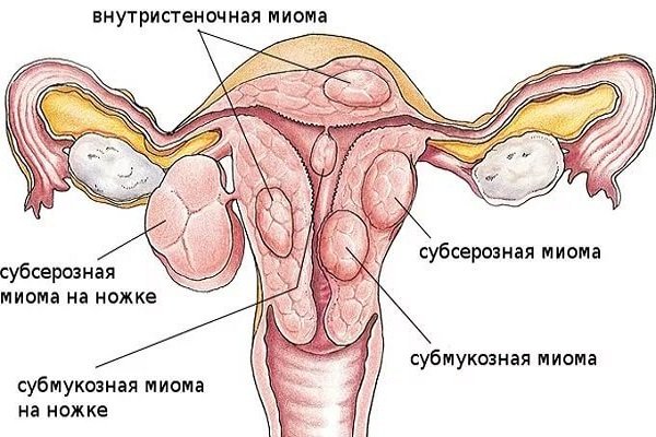 Виды миомы матки