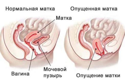 Сущность опущения матки
