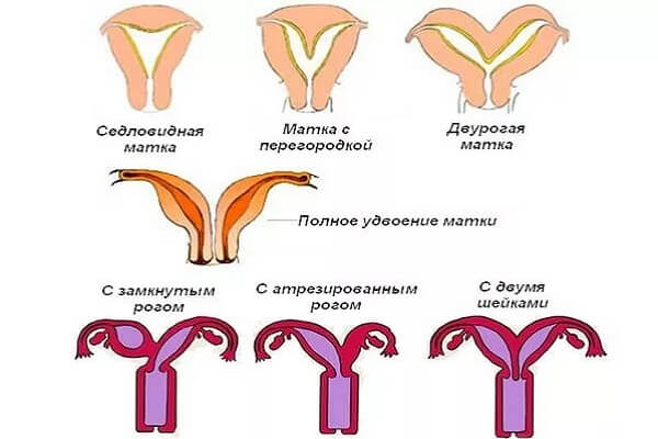 Пороки развития матки