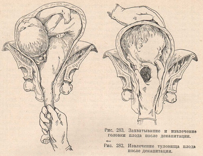 Извлечение туловища плода после декапитации