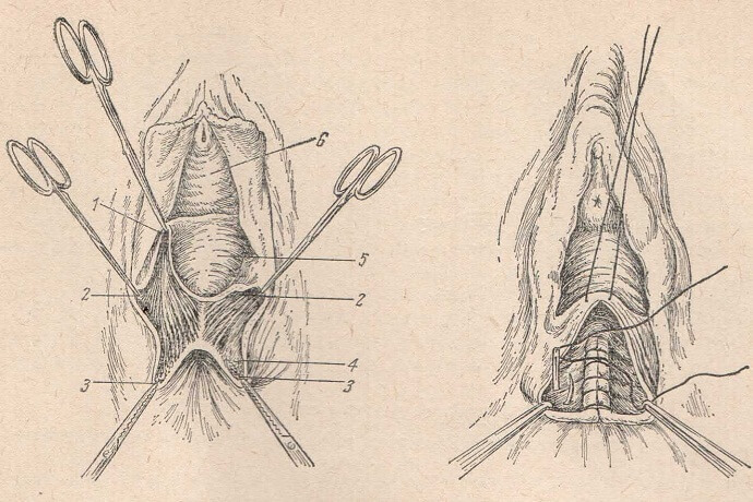 Обнажение и зашивание полного разрыва промежности