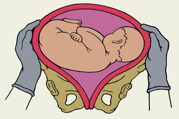 Иногда акушерский поворот жизненно необходим