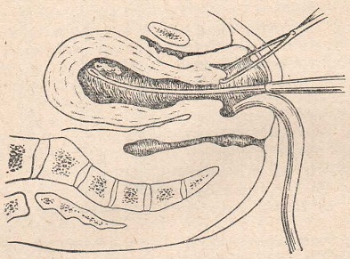 Введение кюретки в полость матки