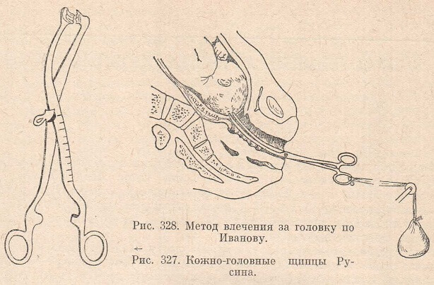 Метод влечения за головку по Иванову