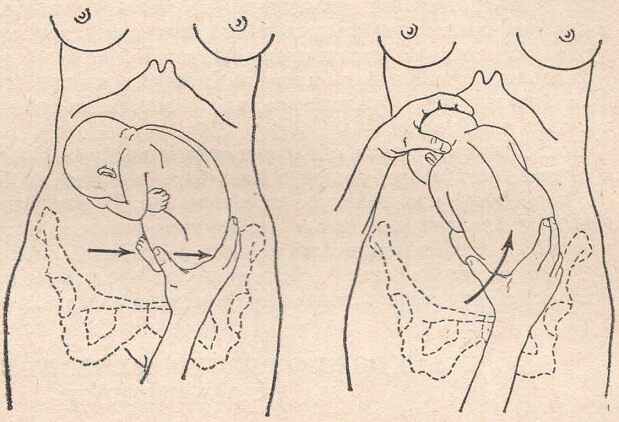 Техника профилактического наружного поворота при тазовом предлежании