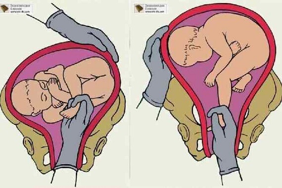 Классический (внутренний) поворота плода на ножку