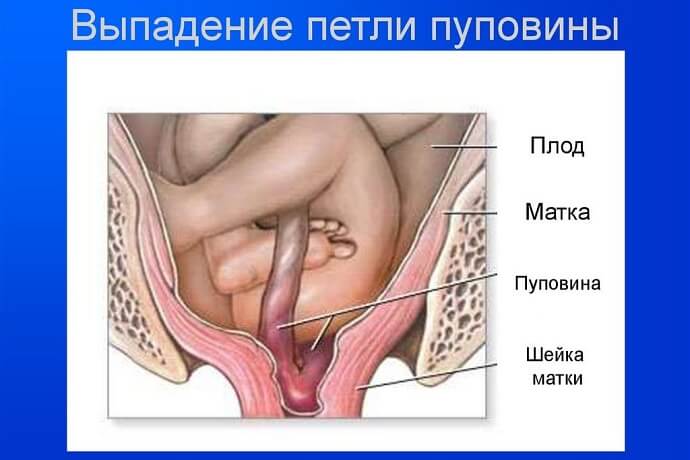 Пример выпадения петли пуповины
