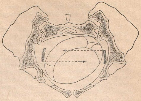 Выпрямляющее действие акушерских щипцов