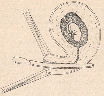 Перфорация матки расширителем