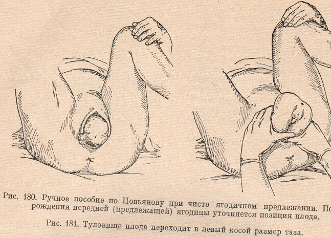 Ручное пособие по Цовьянову при чисто ягодичном предлежании