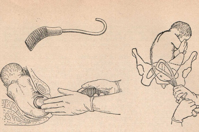 Введение ягодичного крючка при чисто ягодичном предлежании
