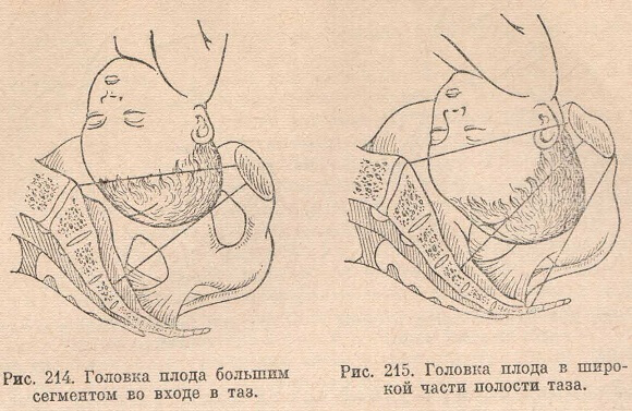 Головка плода большим сегментом во входе в таз
