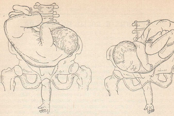 Поперечное положение плода, первая и вторая позиция