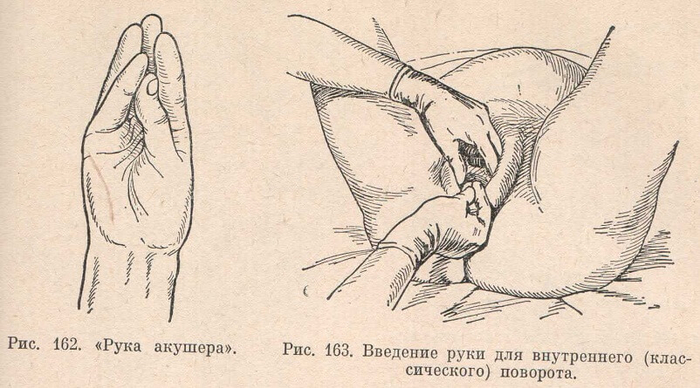 Введение руки для внутреннего (классического) поворота