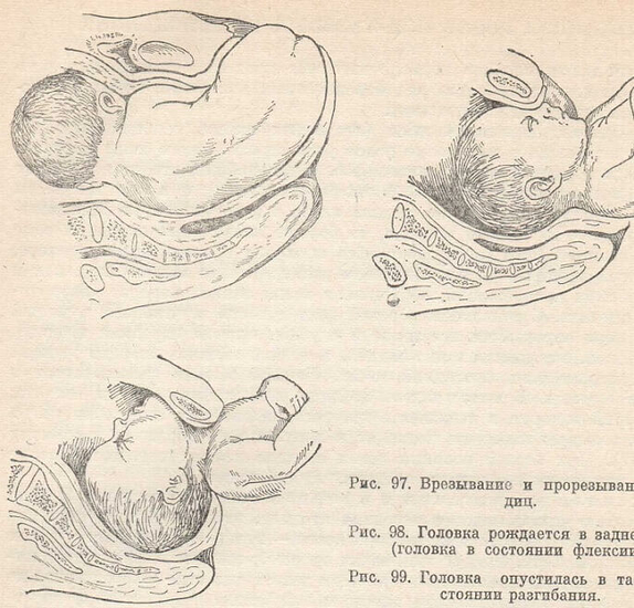 Этапы родов при тазовых предлежаниях