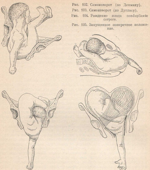 Самоизворот и рождение плода