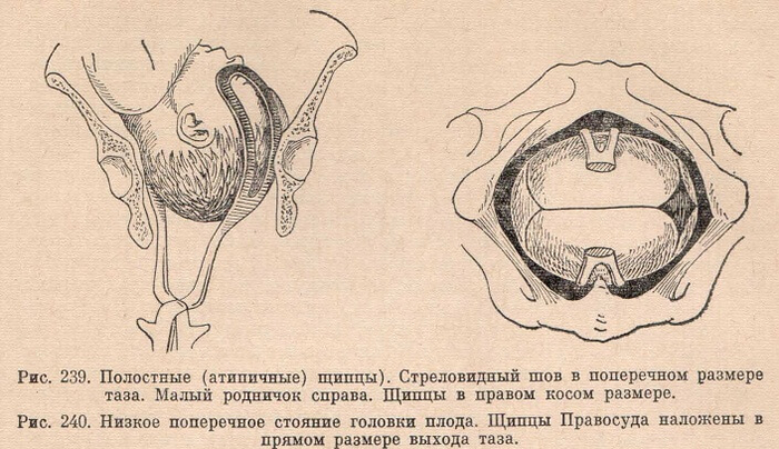 Низкое поперечное стояние головки плода. Щипцы Правосуда