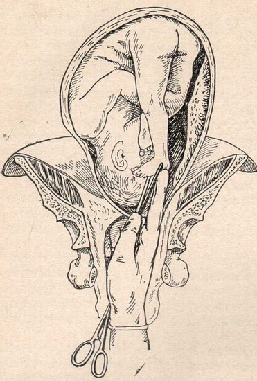 Захватывание ножки плода щипцами при повороте по Брекстону-Гиксу