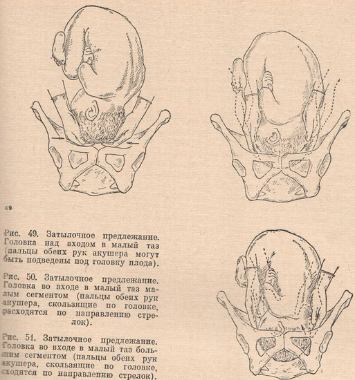 Затылочное предлежание. Положения рук акушера