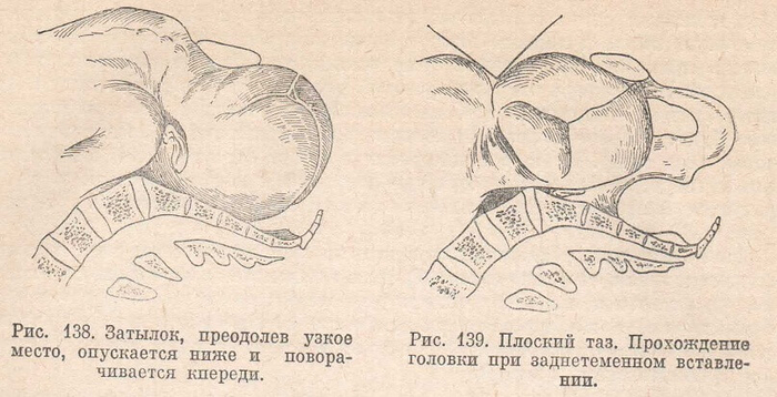 Плоский таз. Прохождение головки при заднетеменном вставлении