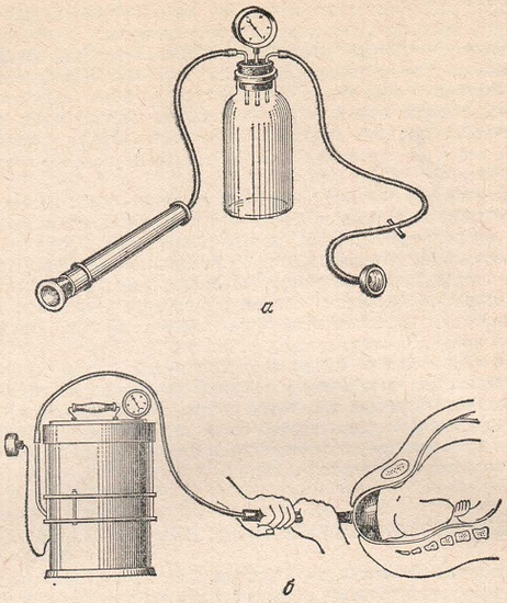 Вакуум-экстрактор. а — модель Мальмстрема; б — модель Чачава-Вашакидзе