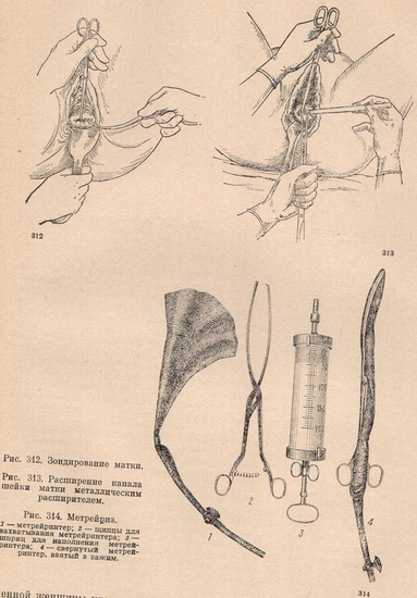Бешеная матка. Расширение шейки матки расширителем Гегара. Зонд для расширения шейки матки.
