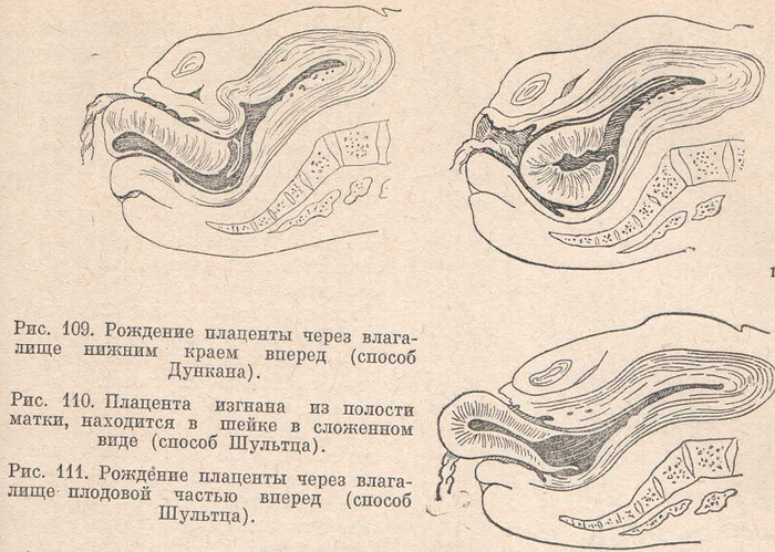 Рождение плаценты через влагалище
