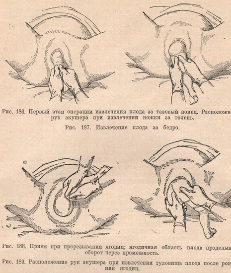 Первый этап операции извлечения плода за тазовый конец