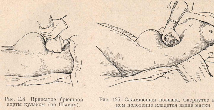 Прижатие брюшной аорты кулаком (по Шмиду)