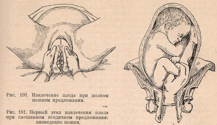 Извлечение плода при полном ножном предлежании