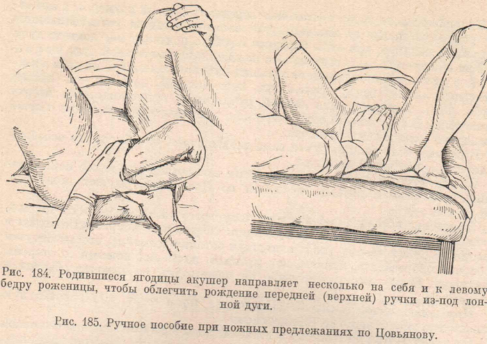 Ручное пособие при ножных предлежаниях по Цовьянову