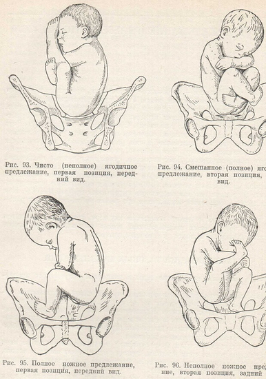 Виды тазовых предлежаний