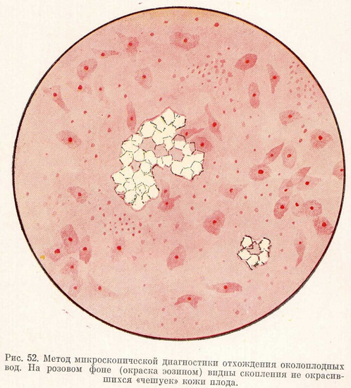 Метод микроскопической диагности отхождения околоплодных вод