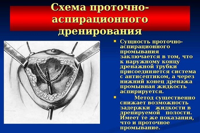Схема проточно-аспирационного дренирования
