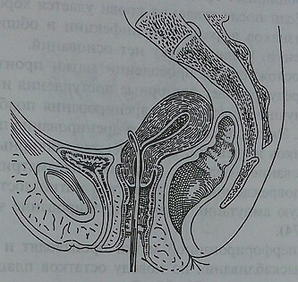 Прободение передней стенки матки на уровне pi. vesico-uterinae